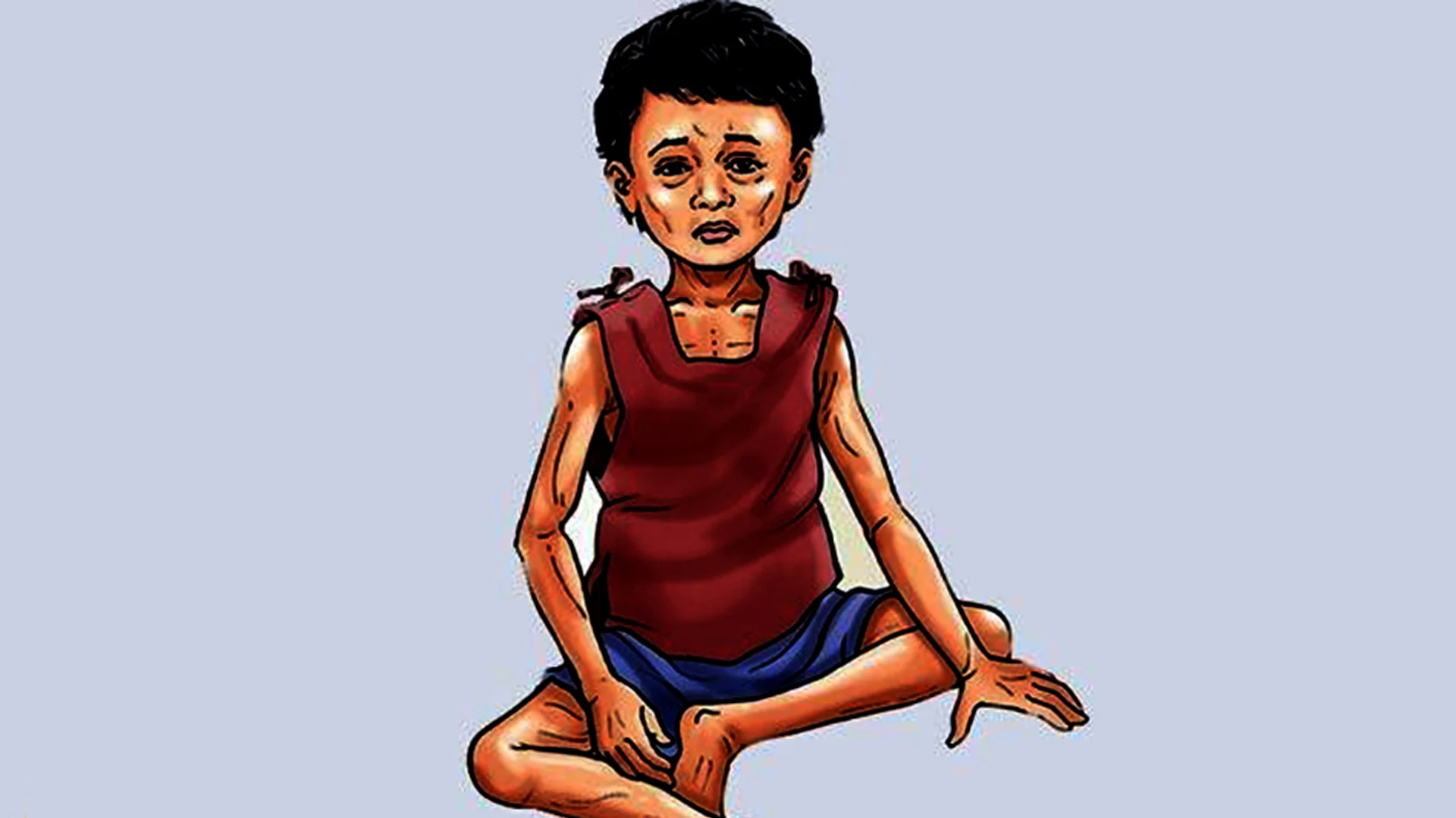 बालबालिकामा कुपोषण बढ्यो